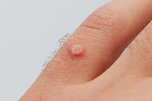 Dermatologist for Warts in Tampa Florida