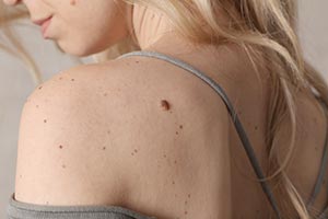 Mole Removal in Tampa Florida