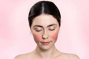 Rosacea Treatments in Tampa Florida