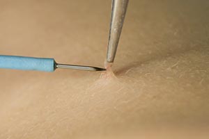 Skin Tag Removal Treatments in Tampa Florida